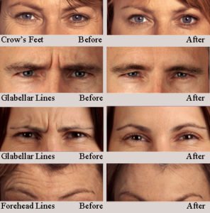 Before and after Botox photos