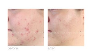 before and after acne