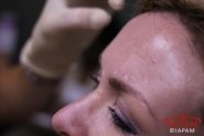 woman patient getting botox injections
