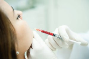 Lip injections with PRP