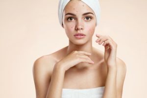 Woman with facial acne