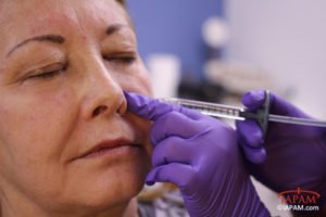 Female patient getting injection by left nostril