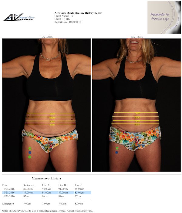 fat removal results from AccuView