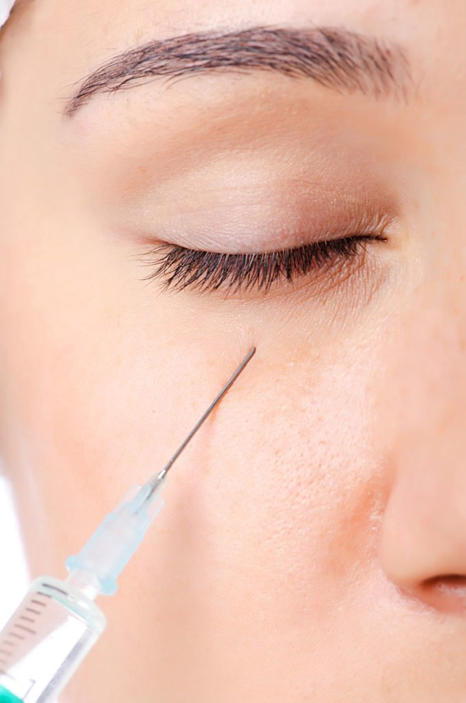 Needle injection below the eye