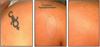 Laser tattoo removal results