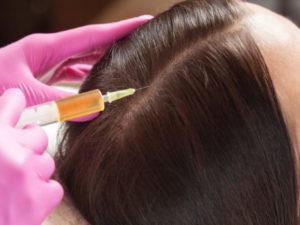 PRP for Hair Restoration