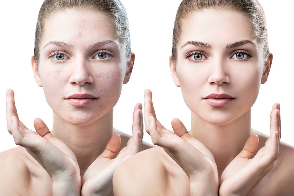 Does Botox® help acne