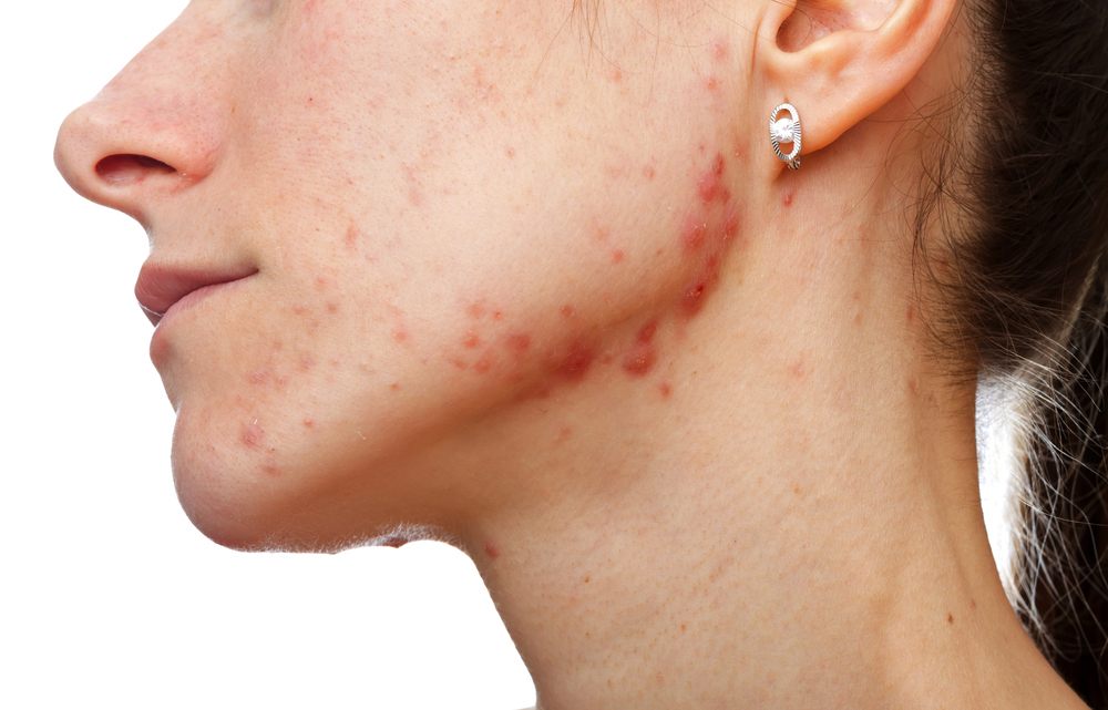 jawline acne