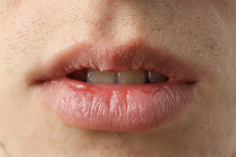 Fordyce Spots on Lips