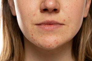 perioral dermatitis