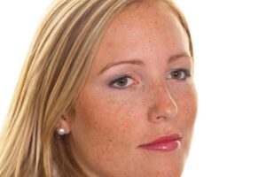 uneven skin tone
