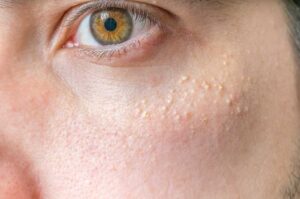 white spot under the eyes