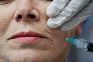 Full Face Botox
