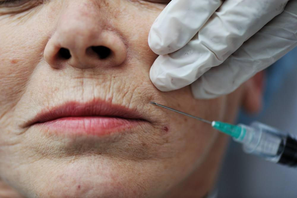 Full face Botox&reg; injection map showing upper, mid, and lower face treatment zones for facial harmony